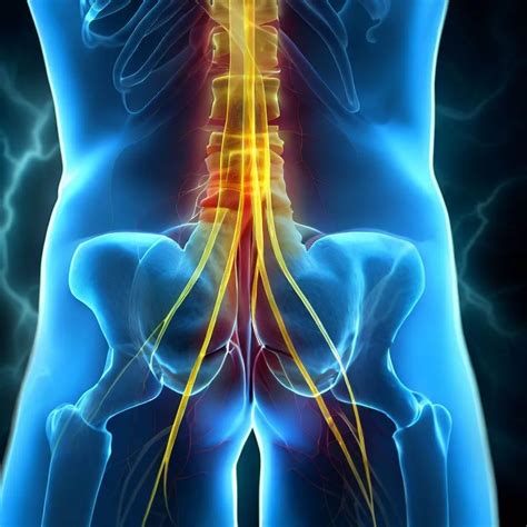 poze cu nervul sciatic|Sciatica aka Inflamația nervului sciatic: Cauze și。